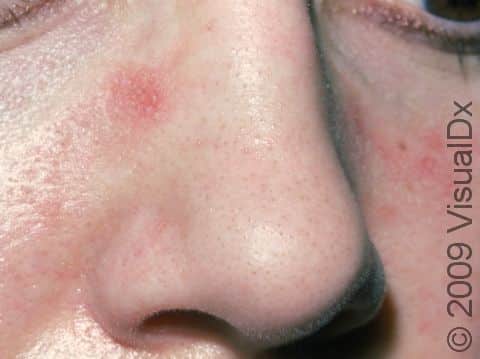 The red areas on the nose and cheeks were caused by an allergic contact dermatitis to an eyeglass frame.