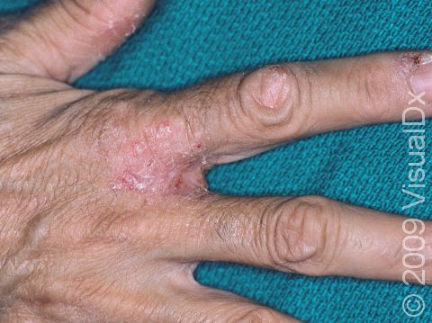 This is irritant contact dermatitis of the web spaces and fingers.