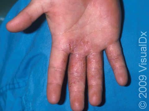 This image displays allergic contact dermatitis on a teenager's hand.