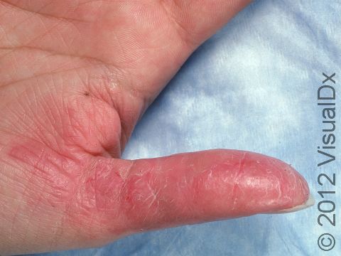 Allergic contact dermatitis often involves the thumb, which can have painful cracks and splits.