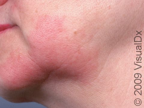 Mild redness and itch are signs of an allergic contact dermatitis.