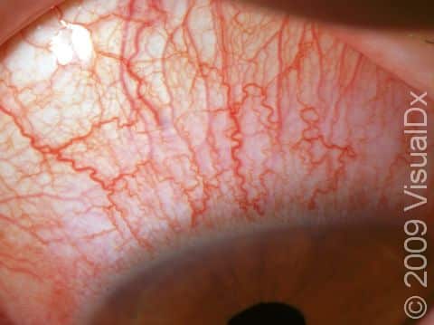 Redness of the eye is the most common finding in contact lens solution toxicity.