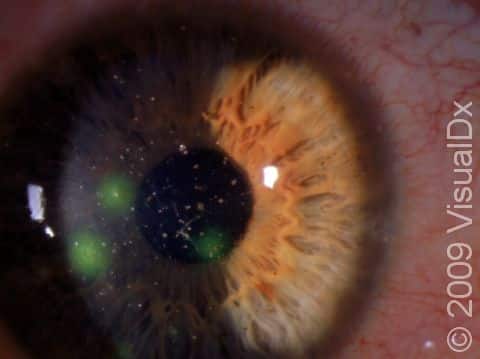 Small corneal abrasions that can't be seen with the naked eye are easily seen with fluorescent dye, which 