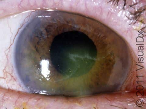 The corneal abrasion can be seen with fluorescein dye, highlighted in green in this image. 