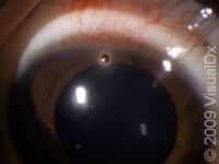 Corneal Foreign Body – Adult