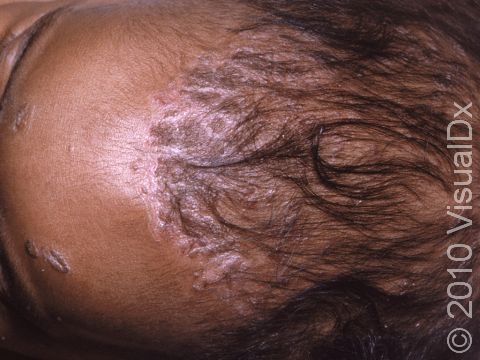 Seborrheic dermatitis often affects the scalp in infants, with a thick, crust-like scale.