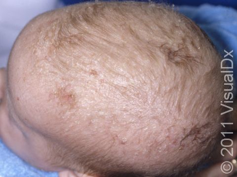 This is a typical, mild case of cradle cap. There is scaling without any redness of the affected skin. 