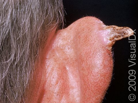 This image displays a cutaneous horn with a squamous cell carcinoma at the base.