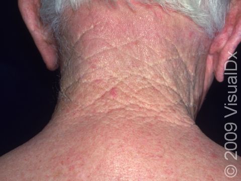 This image displays sun damage to the back of the neck, giving a wrinkled, cross-hatched appearance.