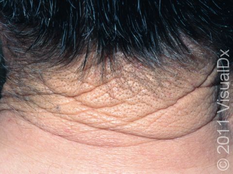 The leathery thickening of the skin seen in cutis rhomboidalis nuchae leads to exaggerated skin lines and hair follicles, as seen in this image.