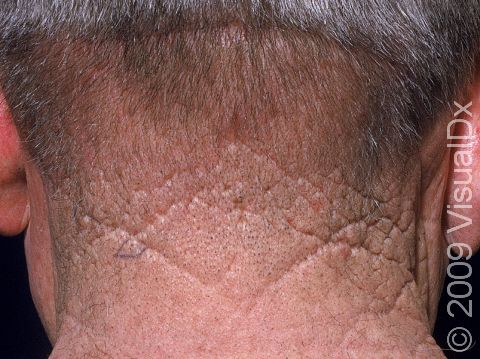 This image displays creases in the neck typical to chronic sun damage and aging.