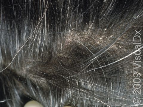 Dandruff Condition, Treatments and Pictures for Adults - Skinsight