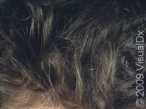 A few flecks of white scale are caught in the hair in this person with dandruff.