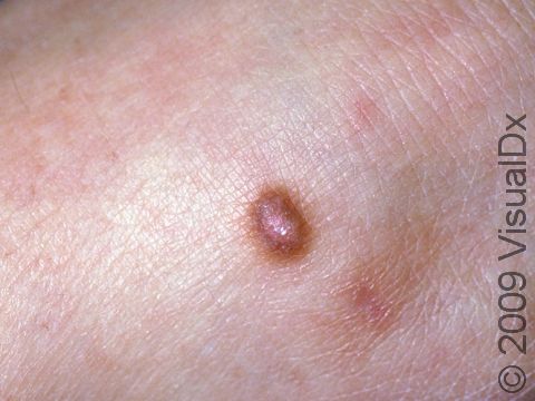 Dermatofibromas are usually very firm to hard to the touch. They are most frequent on the arms and legs but can occur anywhere.