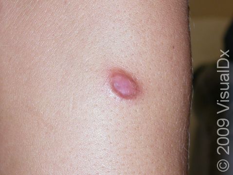 Dermatofibromas frequently occur on the leg, usually as a single firm, raised pink to brown bump.