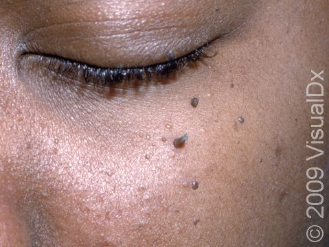 As displayed in this image, the small elevations of the skin of dermatosis papulosa nigra can sometimes develop thicker scaling.