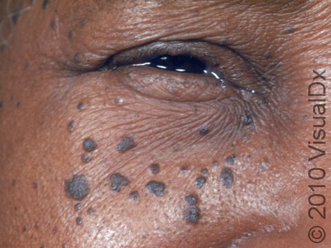 This image displays large, dark elevations of the skin due to dermatosis papulosa nigra.