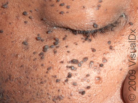 This image displays a severe case of dermatosis papulosa nigra on the face.