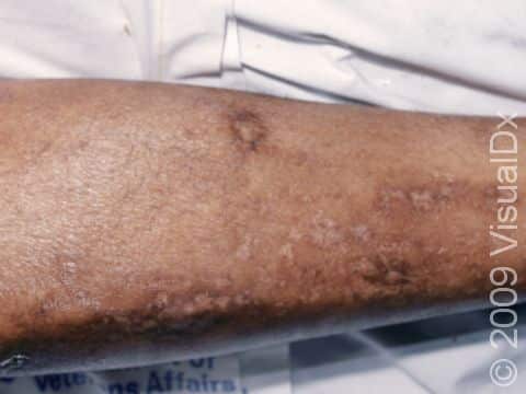 This image displays a close-up of diabetic dermopathy showing scarring.