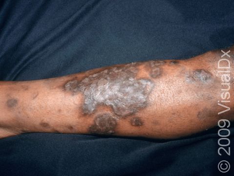 As displayed in this image, the skin lesions of diabetic dermopathy can appear as scaly, colored, slightly elevated lesions.