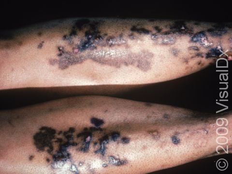 In people with darker skin, the skin lesions of diabetic dermopathy can appear as very dark-colored, slightly elevated lesions, as displayed in this image.