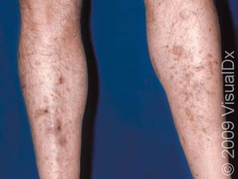 Brown, scar-like, slightly elevated lesions on the legs are typical in long-standing diabetics.