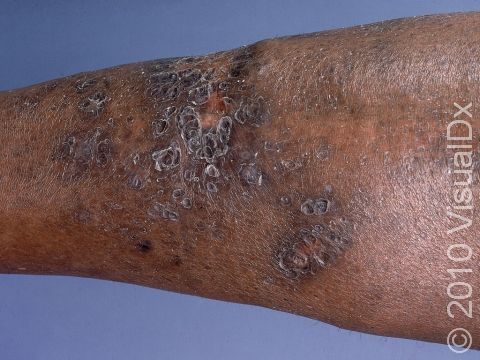 This image displays areas of deep darkening of the skin, scars, and scaliness typical of diabetic dermopathy.