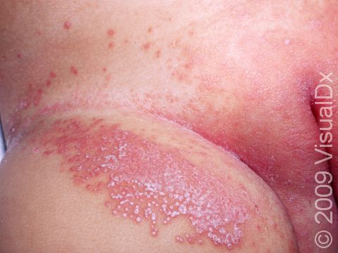Small, white, distinct pus-filled lesions often have associated redness in candida infections, which are often found in the diaper region.