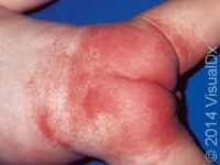 Diaper Rash (Irritant Diaper Dermatitis) – Infant