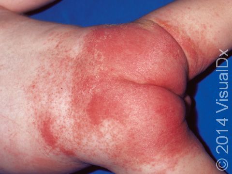 This image displays bright red skin caused by persistent irritation.