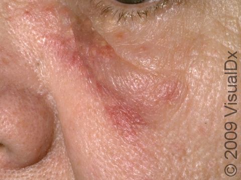 Circular dull, red spots that persist on the face are often the first sign of discoid lupus.