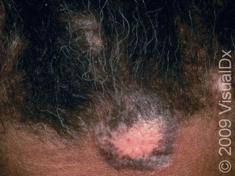 This image displays a patient with chronic discoid lupus.