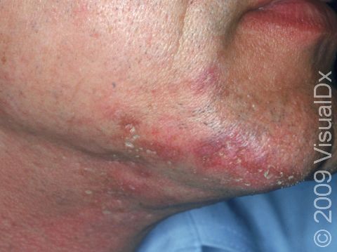 In discoid lupus erythematosus, the skin can appear scarred with redness and scaling, as displayed in this image.