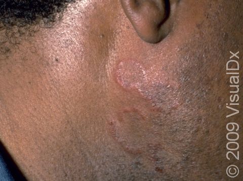This image displays the ring-like, red, slightly elevated lesions typical of discoid lupus erythematosus.