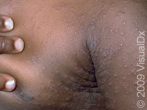 This image displays widespread raised and flat lesions coming together into larger lesions typical of drug rashes (eruptions).