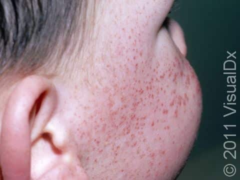 Despite the bright red color and alarming appearance, rashes from medications often do not have symptoms or there is only mild itching present. 