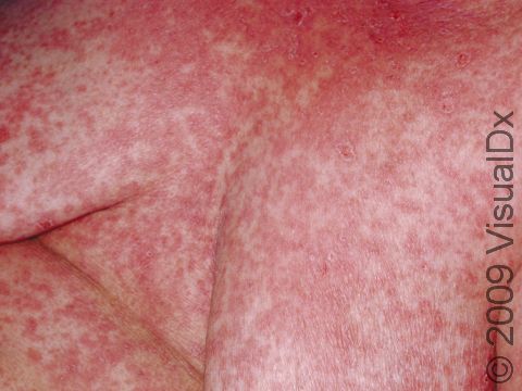 This image displays the widespread red, flat lesions typical of a medication reaction.