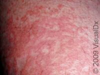 New Itchy Skin Rashes in Adults