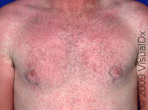 Acute drug eruption with numerous red, raised lesions.