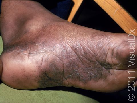This image displays the scaling and cracked areas of the soles of the feet typical of prolonged dyshidrotic eczema.