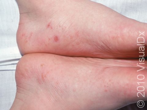 This image displays deep-appearing blisters typical of dyshidrotic dermatitis.