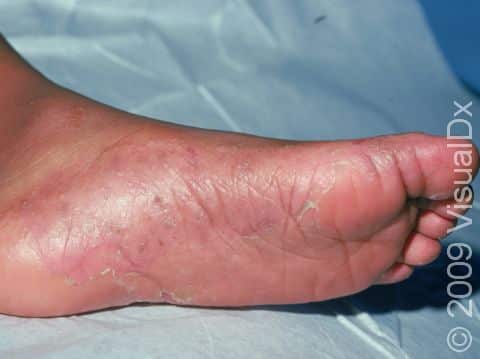 This image displays tiny blisters at the edge of the sole and instep as well as dry, scaling areas.