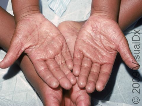 This image displays hands and feet typical of dyshidrotic dermatitis.