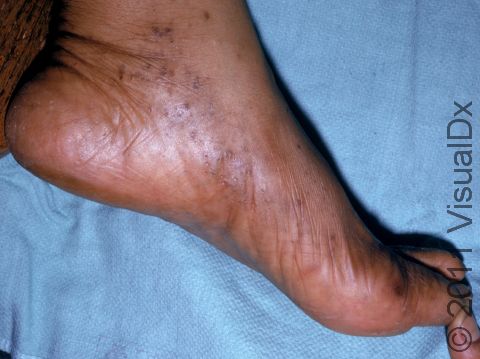 This image displays blisters on the foot of a patient with dyshidrotic dermatitis, which can affect the feet as well as hands.
