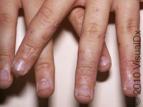 The small blisters of dyshidrotic dermatitis are often hard to see, while the changes of redness and scaling are readily apparent.