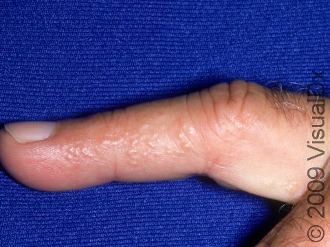 Dyshidrotic dermatitis typically causes small, clear fluid blisters at the sides of the fingers, as displayed in the image.