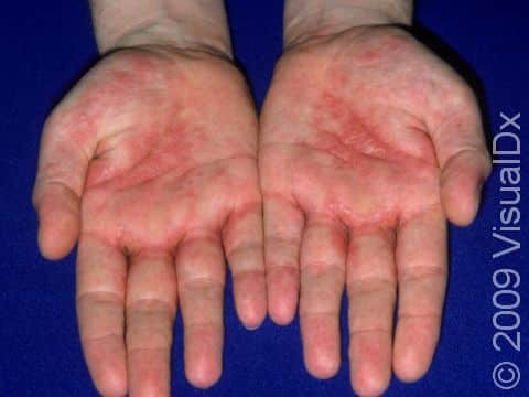 This image displays a severe example of dyshidrotic dermatitis on the palms.