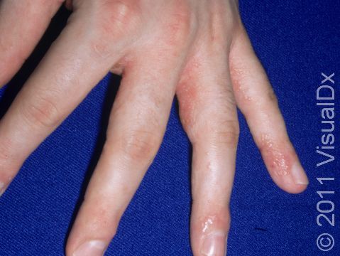 This image displays a typical case of dyshidrotic dermatitis on the fingers.