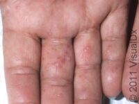 Dyshidrotic Eczema (Dyshidrotic Dermatitis) – Adult