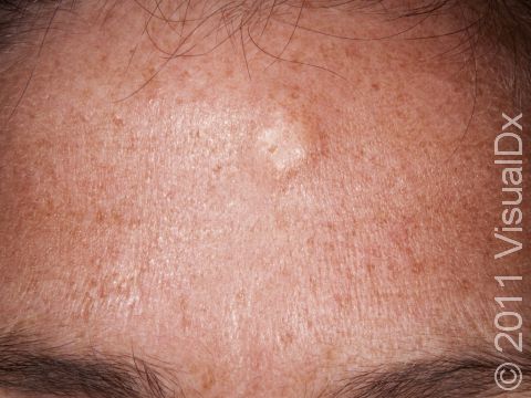 With careful examination, a dilated hair follicle can be seen in the middle of an epidermoid cyst. It often goes unnoticed until the cyst becomes infected and pus drains from the follicle. 